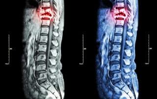 types of minimally invasive spine surgery