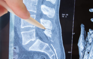 spinal stenosis surgery